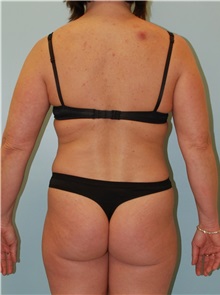 Liposuction Before Photo by Robert Carpenter, MD; Cumberland, MD - Case 32178