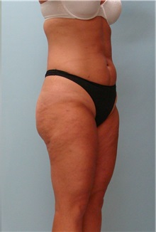 Liposuction After Photo by Robert Carpenter, MD; Cumberland, MD - Case 32180