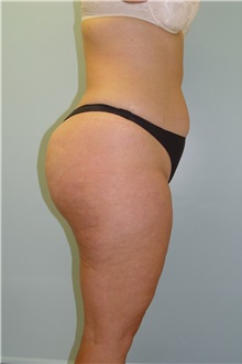 Liposuction Before Photo by Robert Carpenter, MD; Cumberland, MD - Case 32180