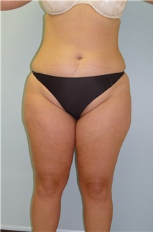 Liposuction Before Photo by Robert Carpenter, MD; Cumberland, MD - Case 32180