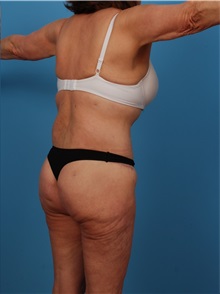 Liposuction After Photo by Robert Carpenter, MD; Cumberland, MD - Case 32183