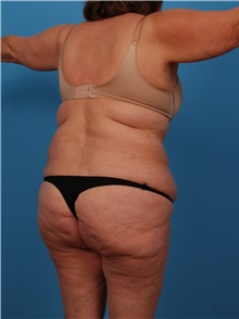 Liposuction Before Photo by Robert Carpenter, MD; Cumberland, MD - Case 32183
