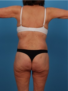 Liposuction After Photo by Robert Carpenter, MD; Cumberland, MD - Case 32183