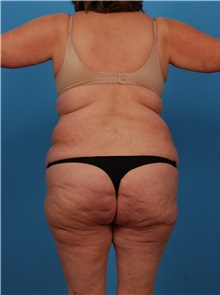 Liposuction Before Photo by Robert Carpenter, MD; Cumberland, MD - Case 32183
