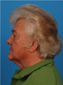 Facelift Before Photo by Robert Carpenter, MD; Cumberland, MD - Case 32188