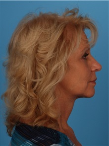 Facelift After Photo by Robert Carpenter, MD; Cumberland, MD - Case 32189