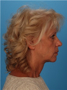 Facelift Before Photo by Robert Carpenter, MD; Cumberland, MD - Case 32189