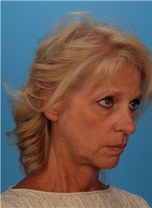 Facelift Before Photo by Robert Carpenter, MD; Cumberland, MD - Case 32189