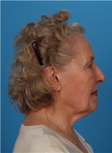 Facelift Before Photo by Robert Carpenter, MD; Cumberland, MD - Case 32190