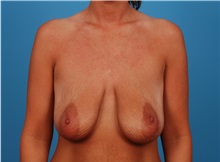 Breast Lift Before Photo by Robert Carpenter, MD; Cumberland, MD - Case 32191