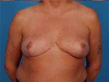 Breast Reduction After Photo by Robert Carpenter, MD; Cumberland, MD - Case 32210