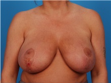 Breast Reduction Before Photo by Robert Carpenter, MD; Cumberland, MD - Case 32210