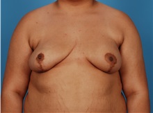 Breast Reconstruction After Photo by Robert Carpenter, MD; Cumberland, MD - Case 32214