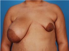 Breast Reconstruction Before Photo by Robert Carpenter, MD; Cumberland, MD - Case 32214