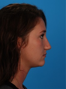 Rhinoplasty After Photo by Robert Carpenter, MD; Cumberland, MD - Case 32217