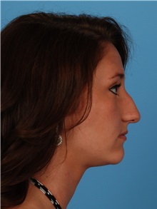 Rhinoplasty Before Photo by Robert Carpenter, MD; Cumberland, MD - Case 32217