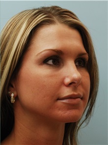 Rhinoplasty After Photo by Robert Carpenter, MD; Cumberland, MD - Case 32219