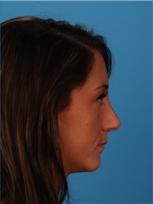 Rhinoplasty After Photo by Robert Carpenter, MD; Cumberland, MD - Case 32220