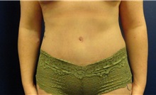 Tummy Tuck After Photo by Anne Taylor, MD; Worthington, OH - Case 33300