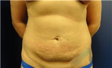 Tummy Tuck Before Photo by Anne Taylor, MD; Worthington, OH - Case 33300