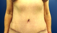 Tummy Tuck After Photo by Anne Taylor, MD; Worthington, OH - Case 33303