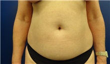 Tummy Tuck Before Photo by Anne Taylor, MD; Worthington, OH - Case 33303