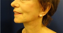 Facelift After Photo by Anne Taylor, MD; Worthington, OH - Case 33305