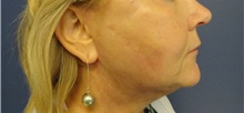 Facelift After Photo by Anne Taylor, MD; Worthington, OH - Case 33307