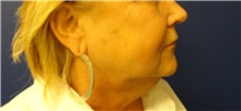 Facelift Before Photo by Anne Taylor, MD; Worthington, OH - Case 33307
