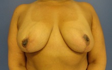 Breast Reduction After Photo by Anne Taylor, MD; Worthington, OH - Case 33421