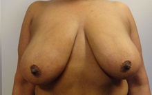 Breast Reduction Before Photo by Anne Taylor, MD; Worthington, OH - Case 33421