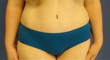 Tummy Tuck After Photo by Anne Taylor, MD; Worthington, OH - Case 33422