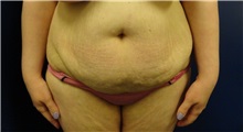 Tummy Tuck Before Photo by Anne Taylor, MD; Worthington, OH - Case 33422
