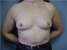 Breast Augmentation Before Photo by Anne Taylor, MD; Worthington, OH - Case 3659