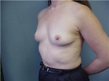 Breast Augmentation Before Photo by Anne Taylor, MD; Worthington, OH - Case 3659