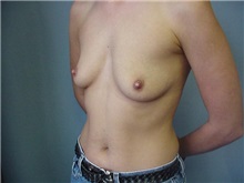 Breast Augmentation Before Photo by Anne Taylor, MD; Worthington, OH - Case 3679