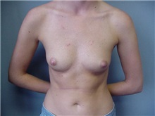 Breast Augmentation Before Photo by Anne Taylor, MD; Worthington, OH - Case 3779
