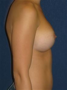 Breast Augmentation After Photo by Michael Eisemann, MD; Houston, TX - Case 27420