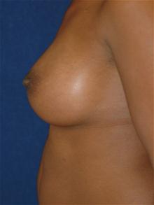 Breast Augmentation After Photo by Michael Eisemann, MD; Houston, TX - Case 27421