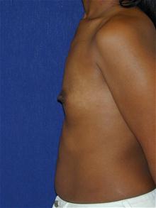 Breast Augmentation Before Photo by Michael Eisemann, MD; Houston, TX - Case 27421