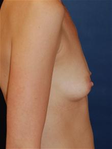 Breast Augmentation Before Photo by Michael Eisemann, MD; Houston, TX - Case 27423