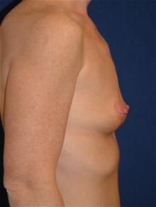 Breast Augmentation Before Photo by Michael Eisemann, MD; Houston, TX - Case 27424