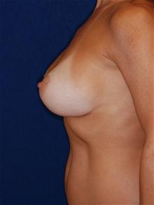 Breast Lift After Photo by Michael Eisemann, MD; Houston, TX - Case 27427