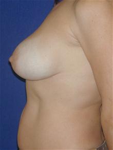 Breast Lift Before Photo by Michael Eisemann, MD; Houston, TX - Case 27427