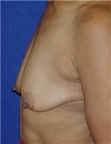 Breast Lift Before Photo by Michael Eisemann, MD; Houston, TX - Case 27428