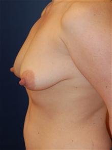 Breast Lift Before Photo by Michael Eisemann, MD; Houston, TX - Case 27429