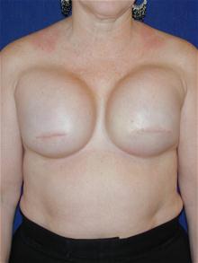 Breast Reconstruction Before Photo by Michael Eisemann, MD; Houston, TX - Case 27442