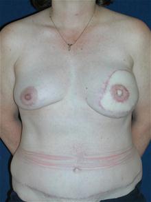 Breast Reconstruction After Photo by Michael Eisemann, MD; Houston, TX - Case 27443