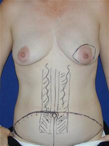 Breast Reconstruction Before Photo by Michael Eisemann, MD; Houston, TX - Case 27443