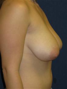 Breast Reduction Before Photo by Michael Eisemann, MD; Houston, TX - Case 27445